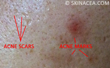 Acne Scars vs. Marks