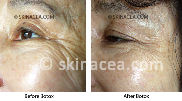 Botox: Before and After Pictures