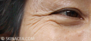 Preventing wrinkles and aging