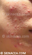 My acne before it got really bad
