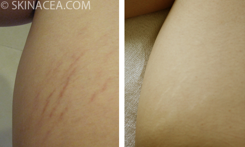Stretch marks before and after on my inner right thigh