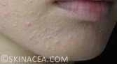 How to Get Rid of Clogged Pores | Skinacea.com